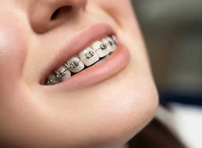 Clear and metal braces
