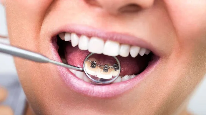 Hidden lingual braces comparison showing braces on inside of teeth