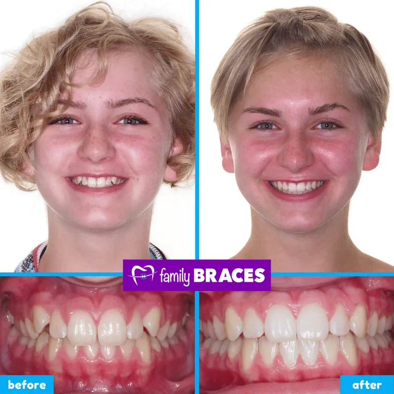 Before & after result 11