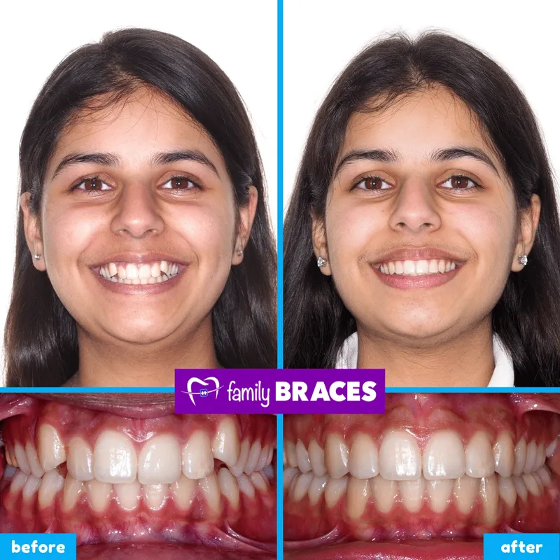 Before & after result 13