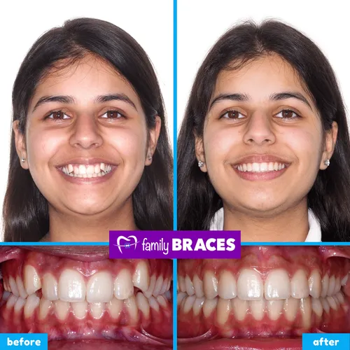 Before and after orthodontic treatment result 13