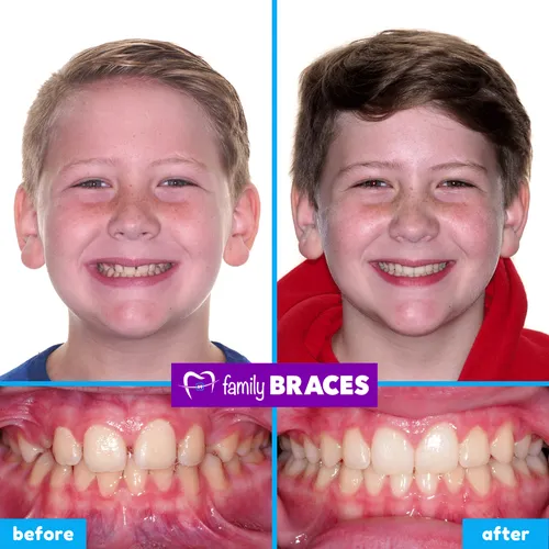 Before and after orthodontic treatment result 14