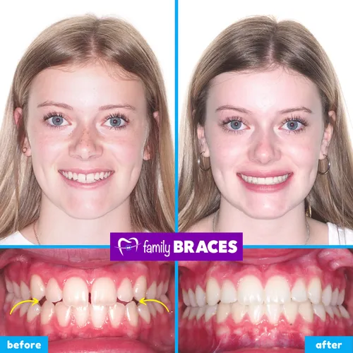 Before and after orthodontic treatment result 16