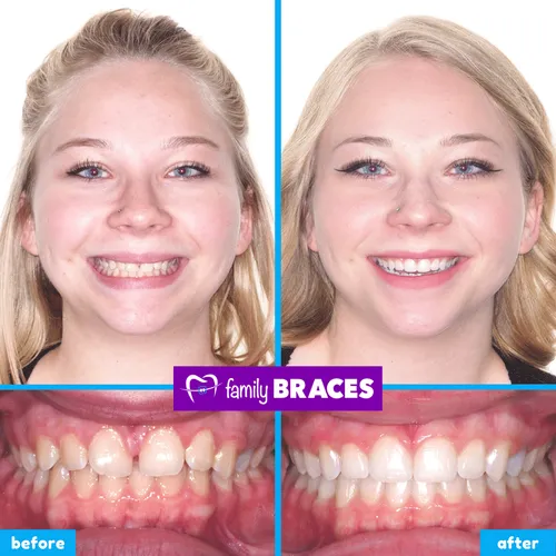 Before and after orthodontic treatment result 3