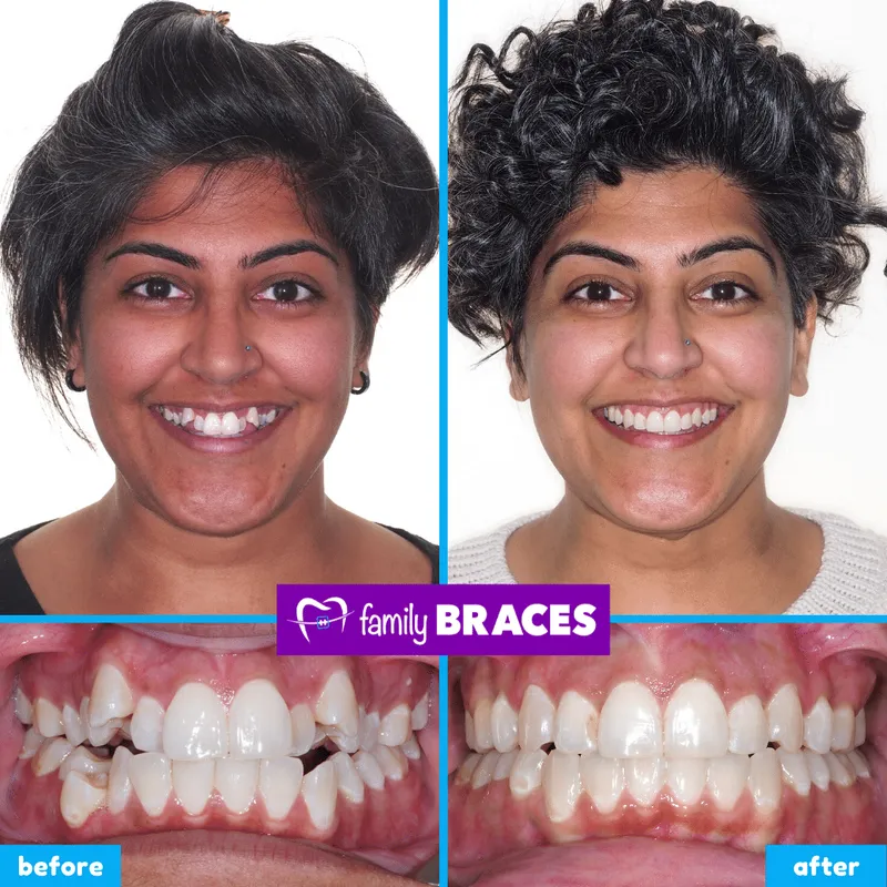 Before & after result 4