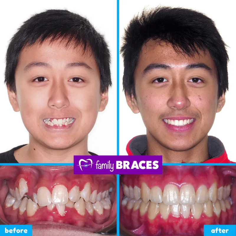 Before & after result 6