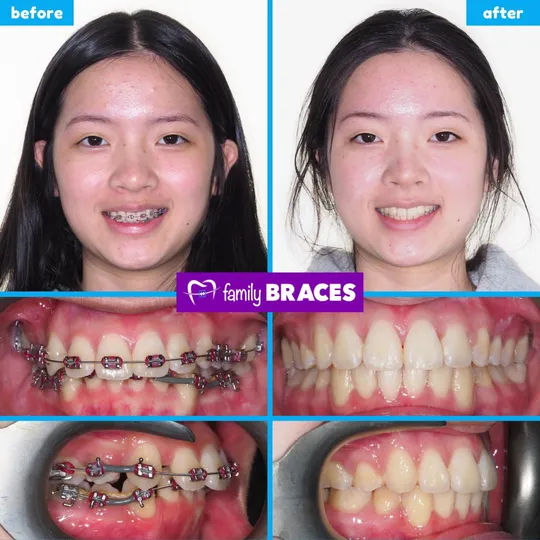 Family Braces Instagram post