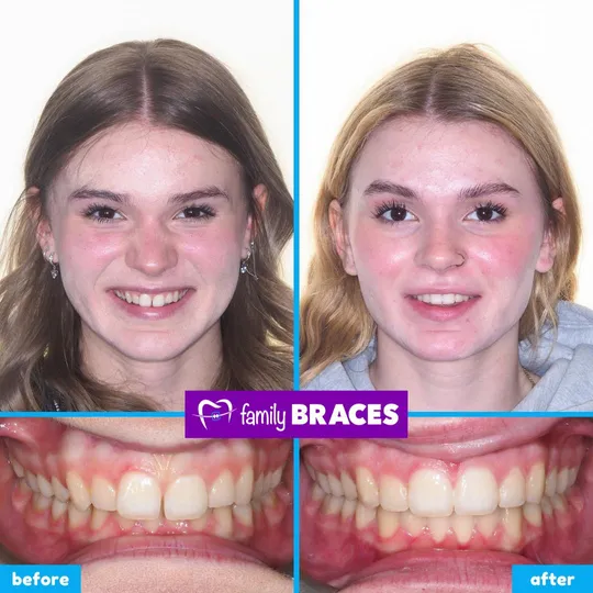 Family Braces Instagram post