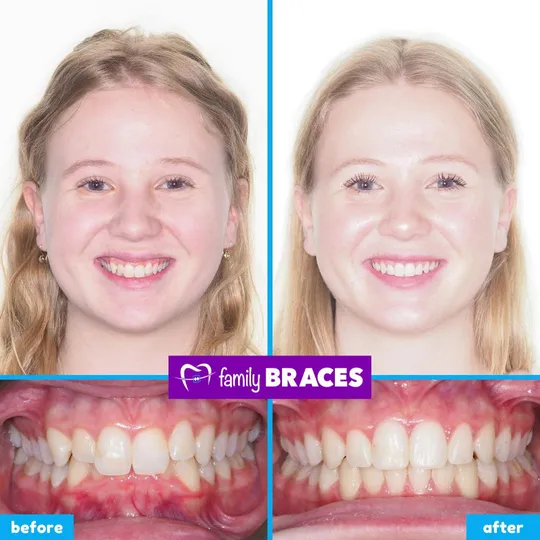 Family Braces Instagram post