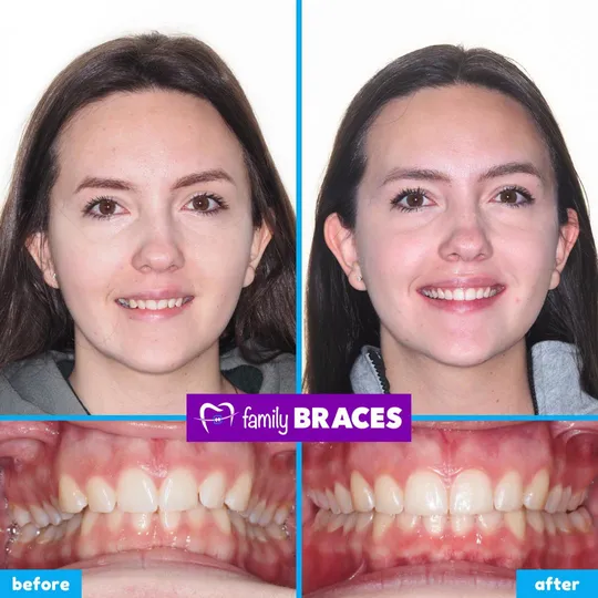 Family Braces Instagram post