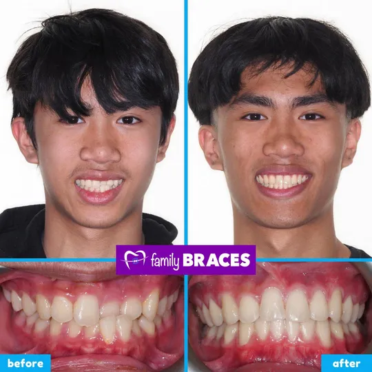 Family Braces Instagram post