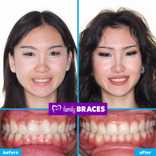 Family Braces Instagram post